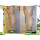 venöse Störung zu Hause Behandlung eingestellt