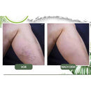 venöse Störung zu Hause Behandlung eingestellt