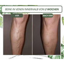 venöse Störung zu Hause Behandlung eingestellt