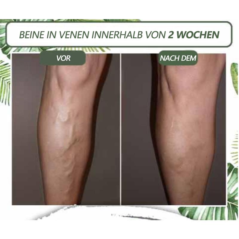 venöse Störung zu Hause Behandlung eingestellt
