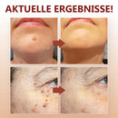 Essenz zur Entfernung von Flecken und Muttermalen - 1 kaufen, 1 gratis erhalten (2 Stück)