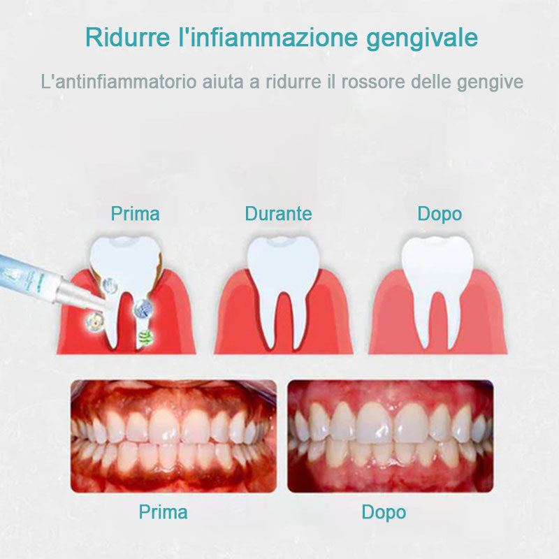 Gel per la riparazione dei denti (acquista 1 prendi 1 gratis)