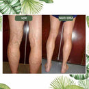 venöse Störung zu Hause Behandlung eingestellt